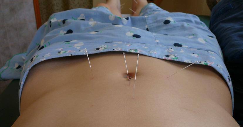 acupuncture appointment