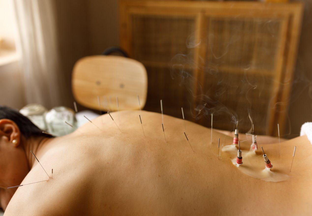 Relaxed female patient lying on treatment table having rest while her nude back being covered with acupuncture sterile needles and burning moxa. Unrecognizable woman undergoing moxibustion therapy